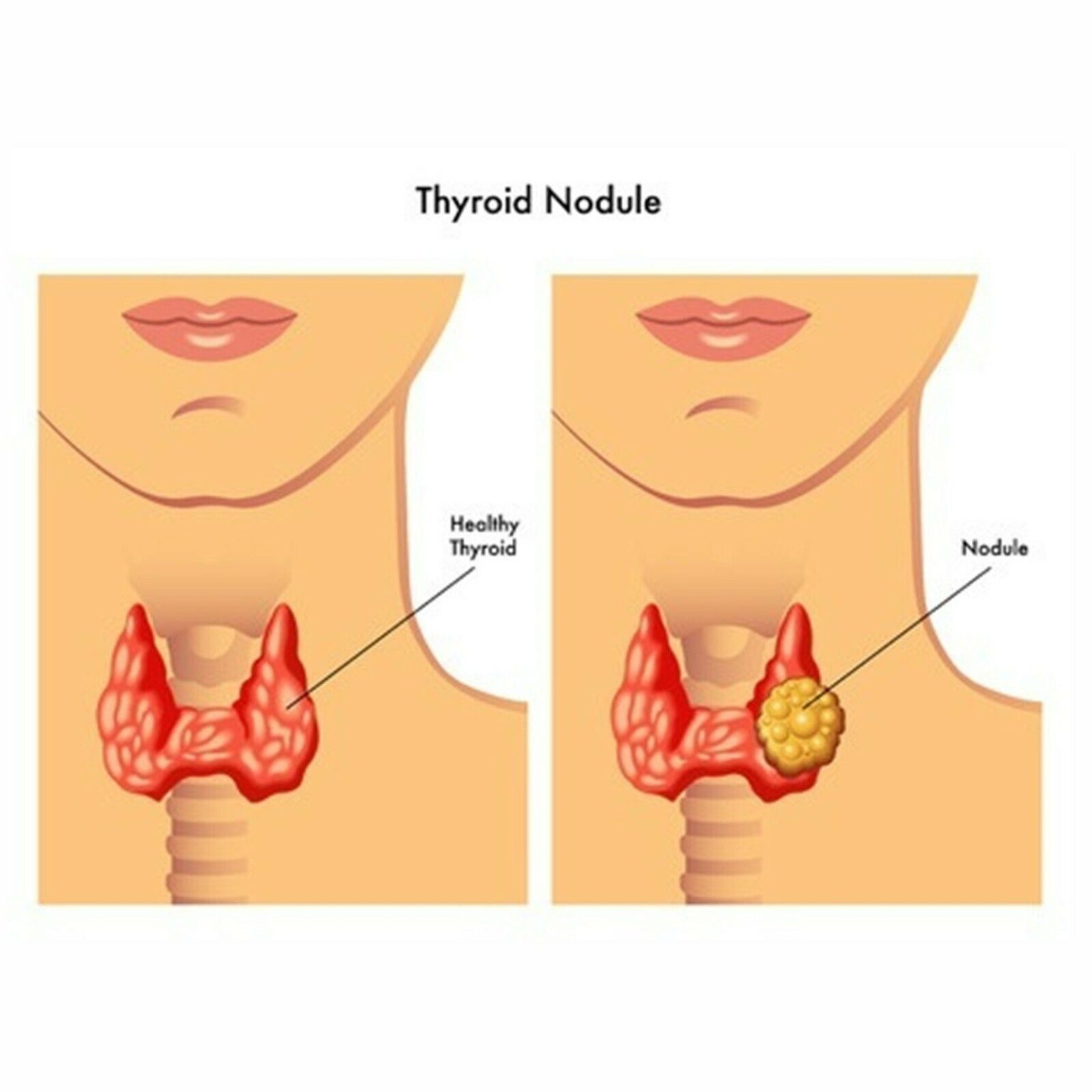 THYROIDS NDT Natural Desiccated Thyroid Thyroid Extract 60mg ,1000